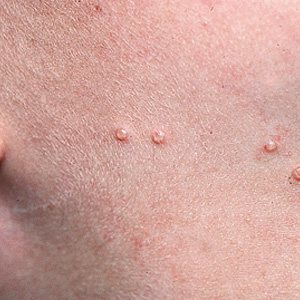 Mollusco contagioso e verruche: cosa li distingue?