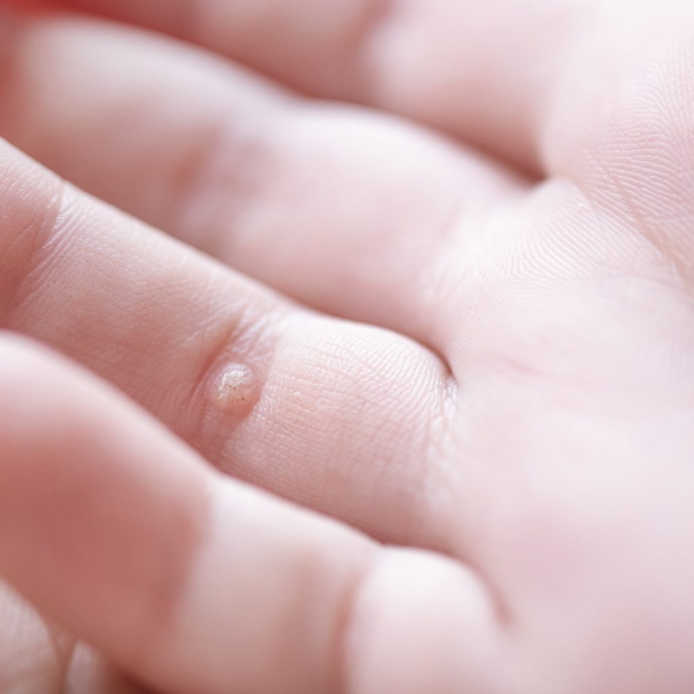 Child hand with warts. Pediatric dermatology concept. Papillomav